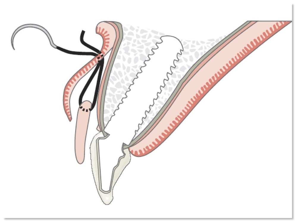  image implant connective tissue graft